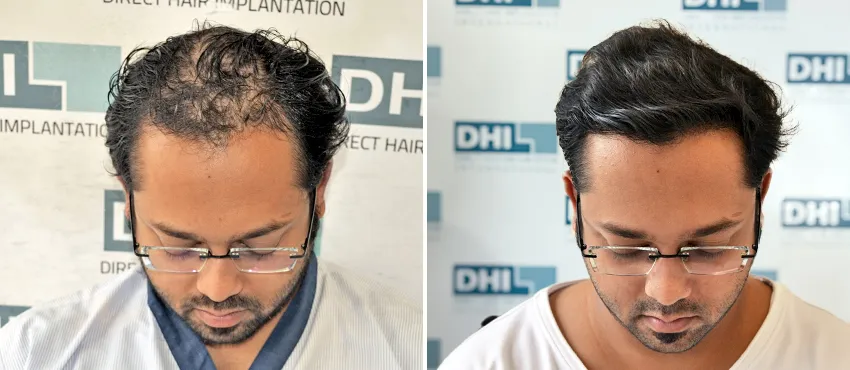 DHI before & after hair transplant results