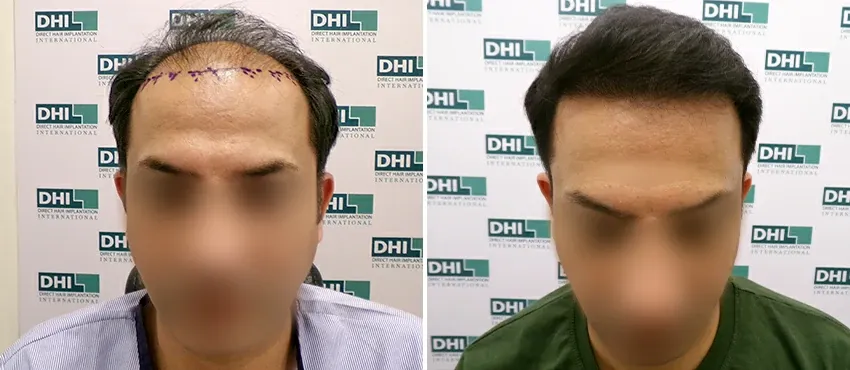 DHI before & after hair transplant results