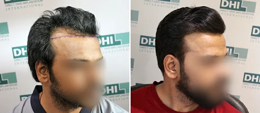 DHI before & after hair transplant results