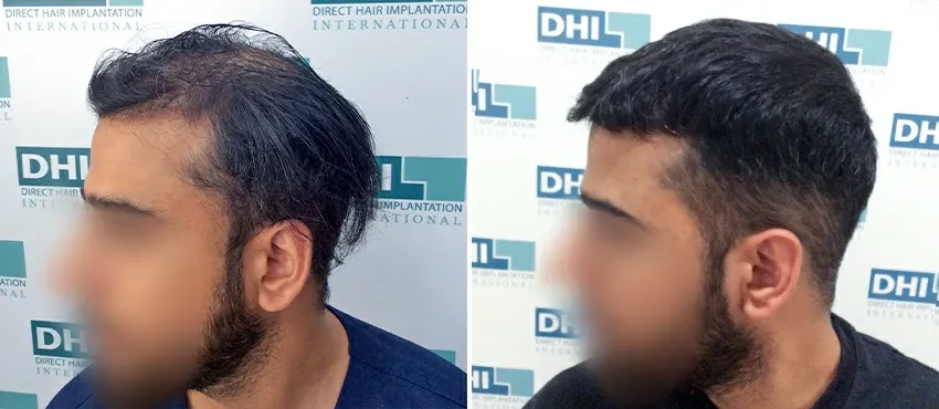 DHI before & after hair transplant results