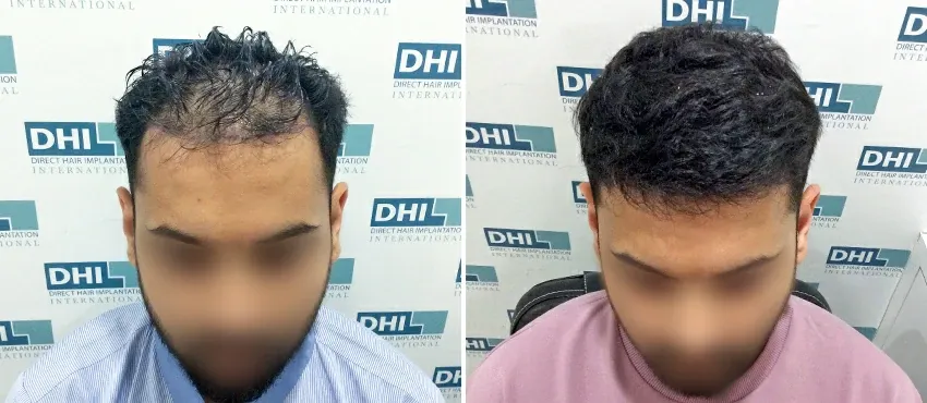 DHI before & after hair transplant results