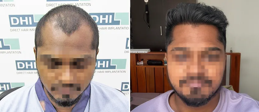 DHI before & after hair transplant results
