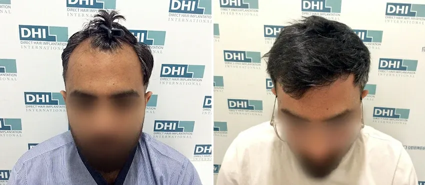 DHI before & after hair transplant results