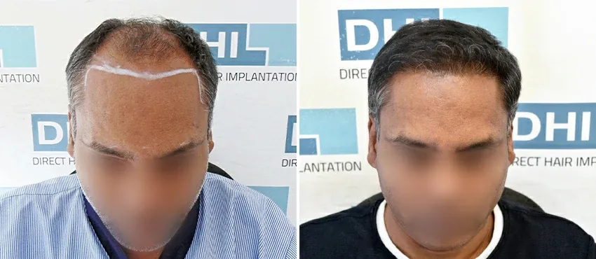 DHI before & after hair transplant results