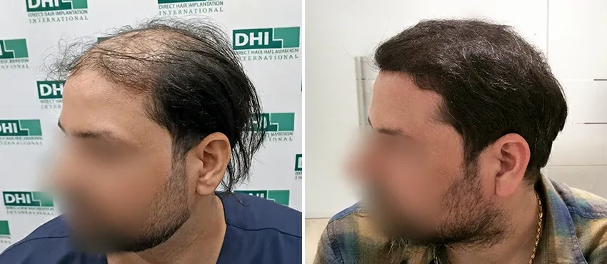 DHI before & after hair transplant results