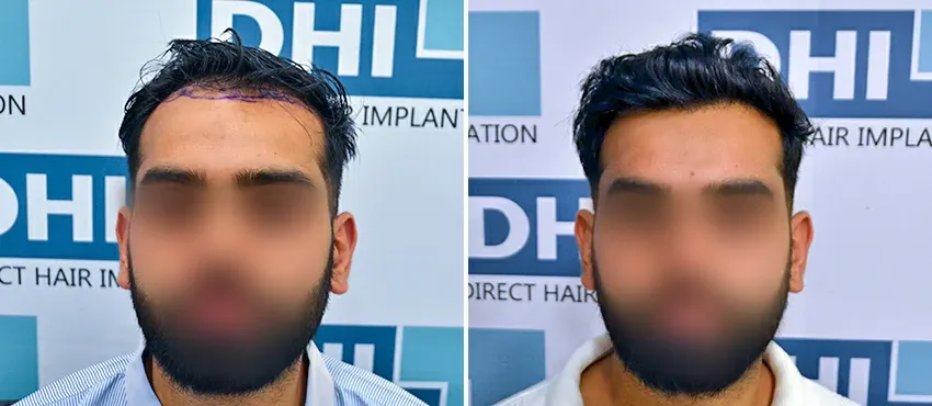 DHI before & after hair transplant results