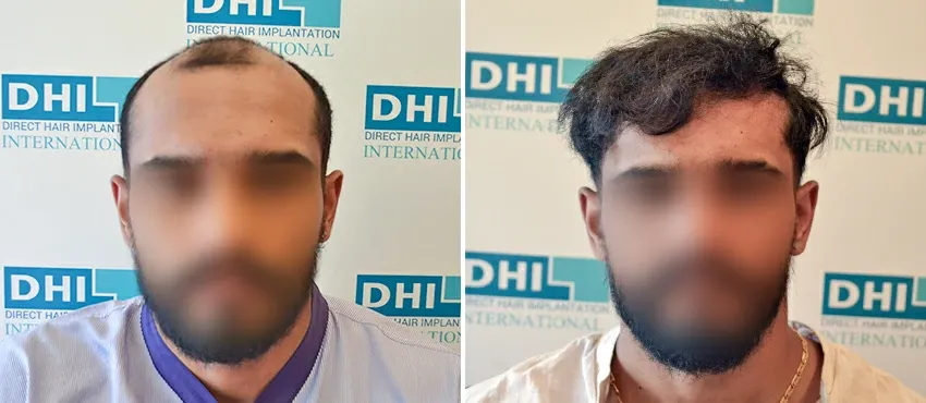 DHI before & after hair transplant results