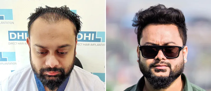 dhi gives natural hairline