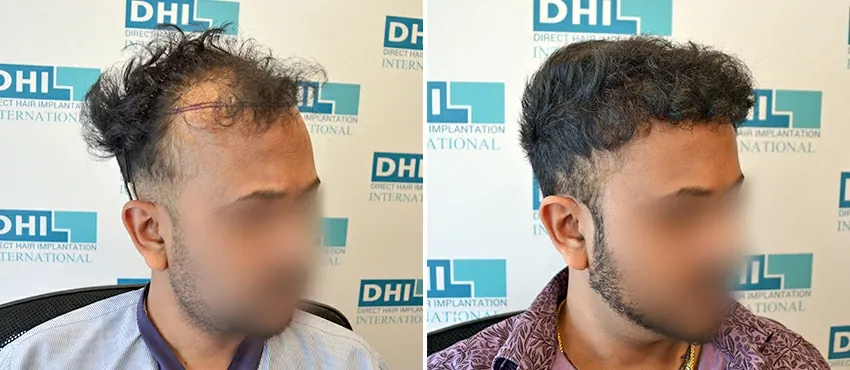DHI before & after hair transplant results