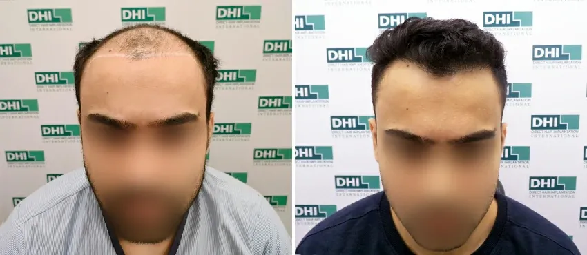 DHI before & after hair transplant results