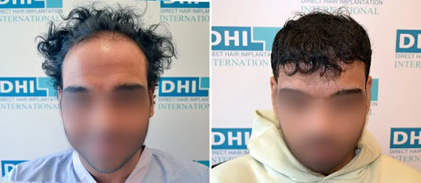 DHI before & after hair transplant results