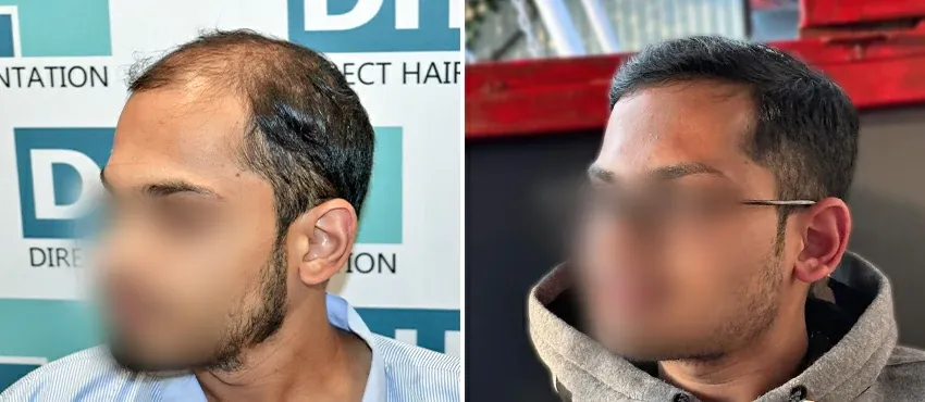 DHI before & after hair transplant results