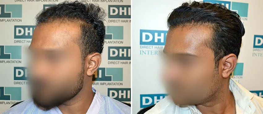 DHI before & after hair transplant results