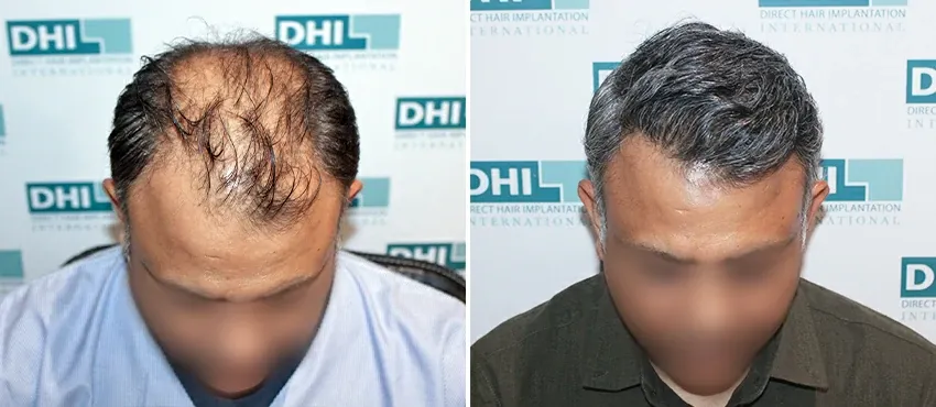 DHI before & after hair transplant results