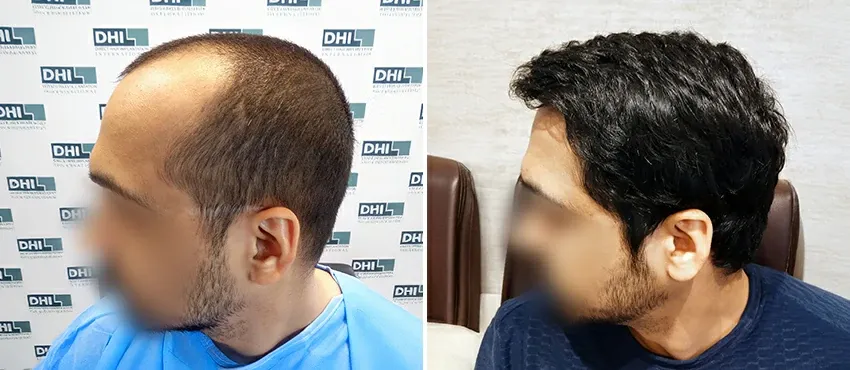 DHI before & after hair transplant results