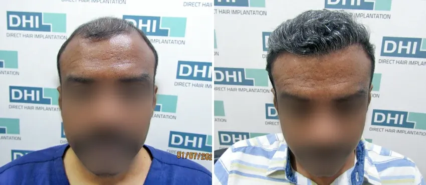 DHI before & after hair transplant results