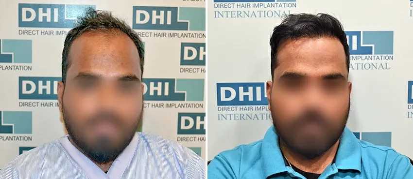 DHI before & after hair transplant results