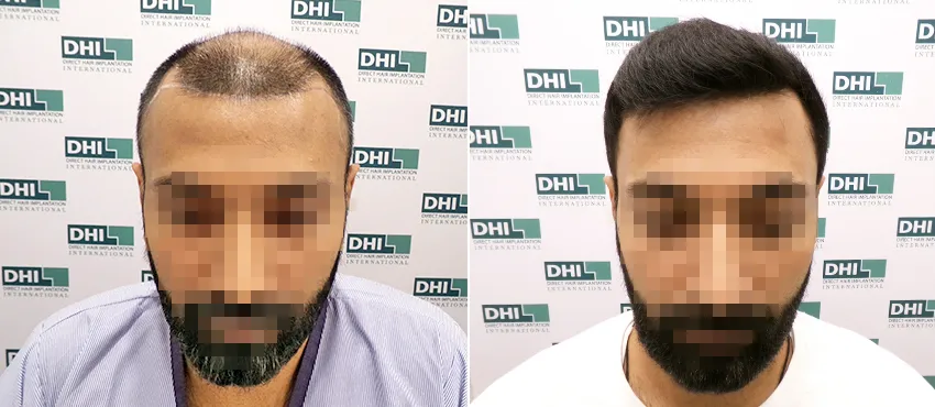 DHI before & after hair transplant results