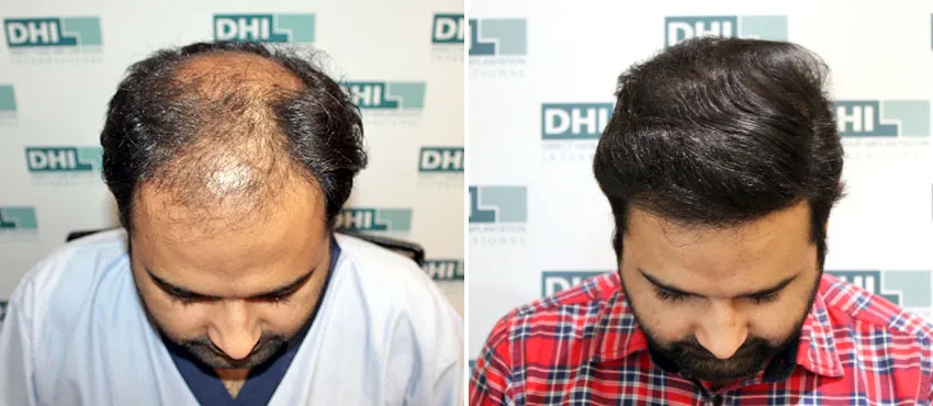 dhi gives natural hairline