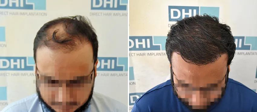 DHI before & after hair transplant results