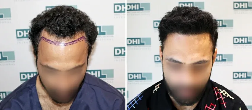 DHI before & after hair transplant results
