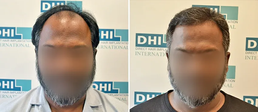 DHI before & after hair transplant results