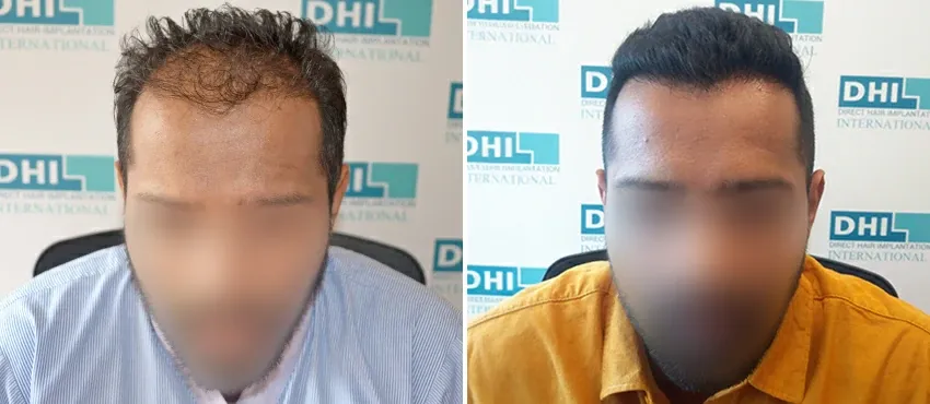 DHI before & after hair transplant results