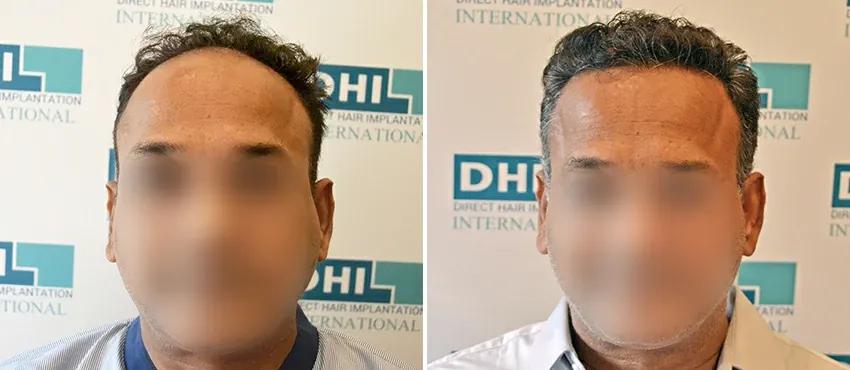 DHI before & after hair transplant results