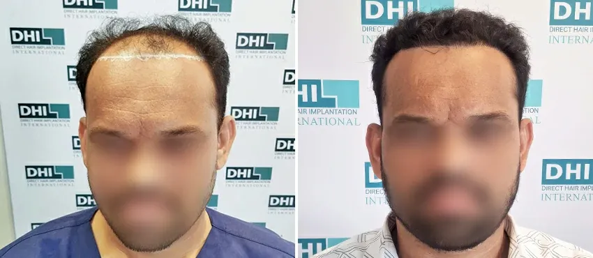 DHI before & after hair transplant results