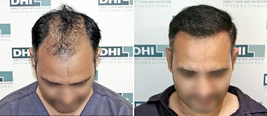 DHI before & after hair transplant results