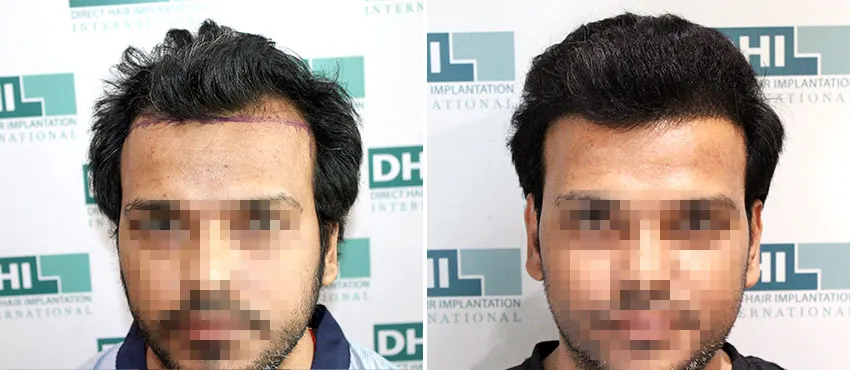 DHI before & after hair transplant results