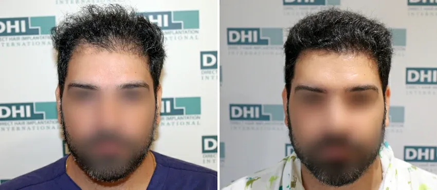 DHI before & after hair transplant results