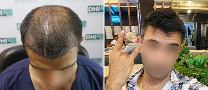 DHI before & after hair transplant results
