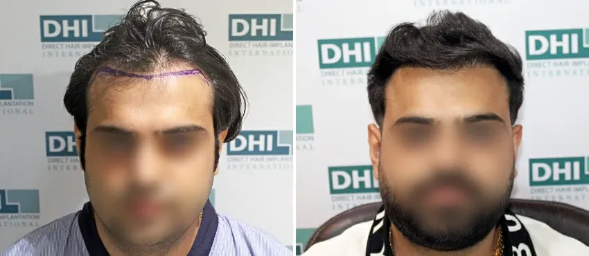 DHI before & after hair transplant results