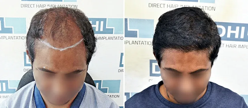 DHI before & after hair transplant results