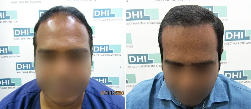 DHI before & after hair transplant results