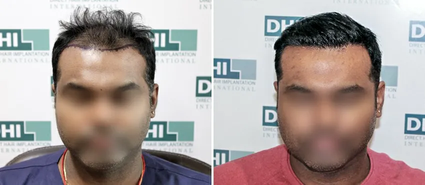 DHI before & after hair transplant results