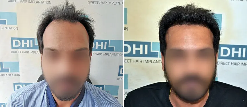 DHI before & after hair transplant results