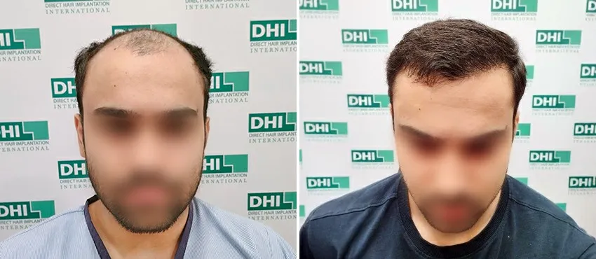 DHI before & after hair transplant results