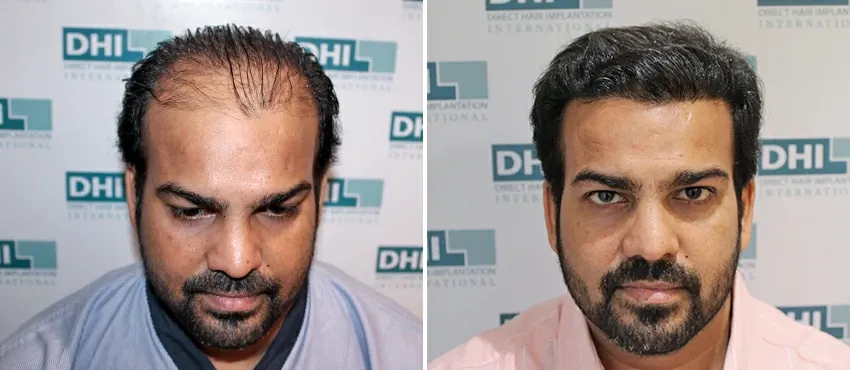 dhi gives natural hairline