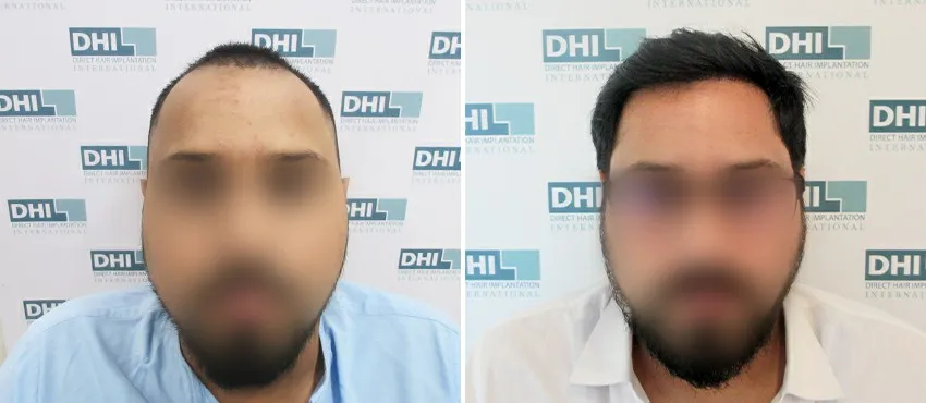 DHI before & after hair transplant results
