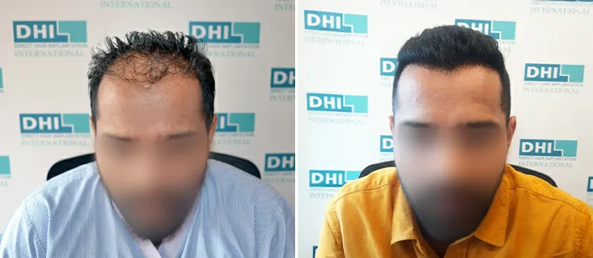 DHI before & after hair transplant results