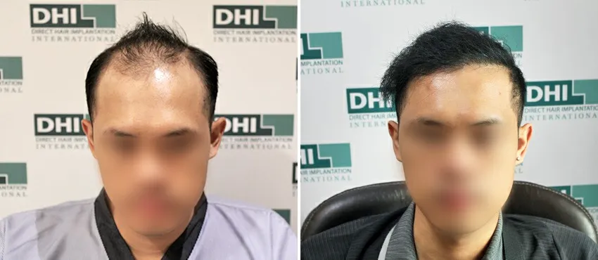 DHI before & after hair transplant results