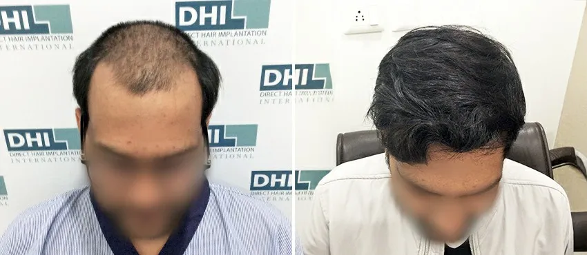DHI before & after hair transplant results