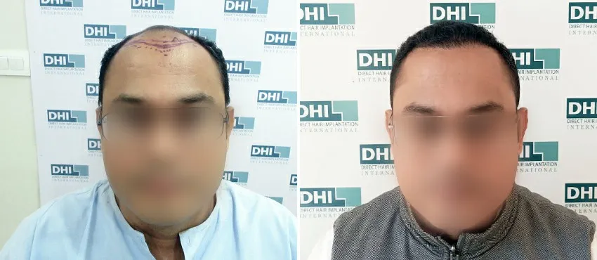 DHI before & after hair transplant results