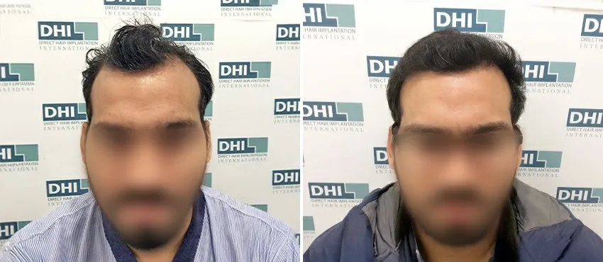 DHI before & after hair transplant results