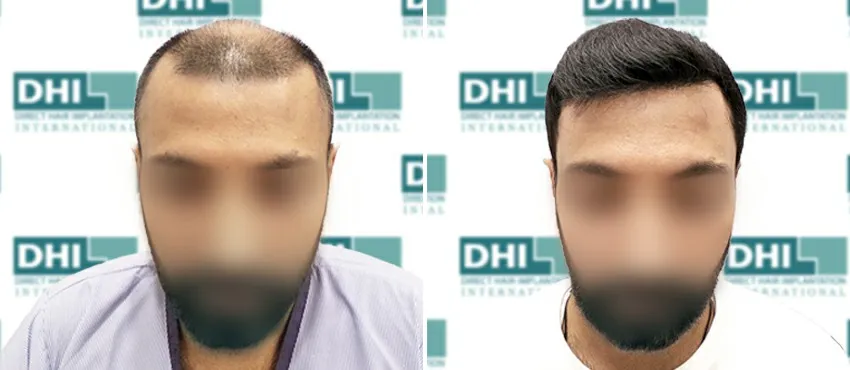 DHI before & after hair transplant results