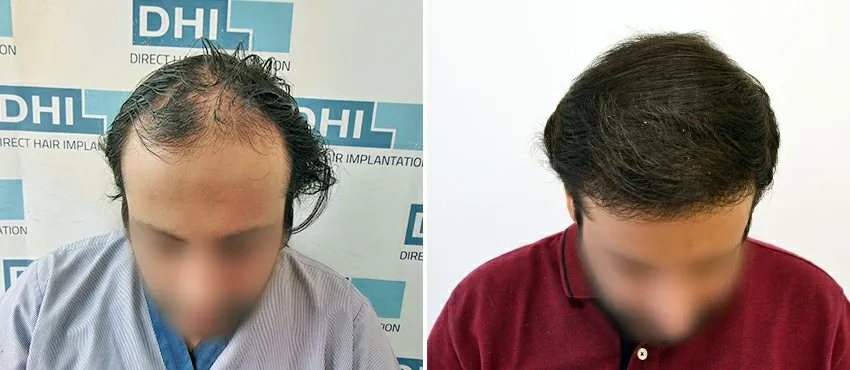 DHI before & after hair transplant results