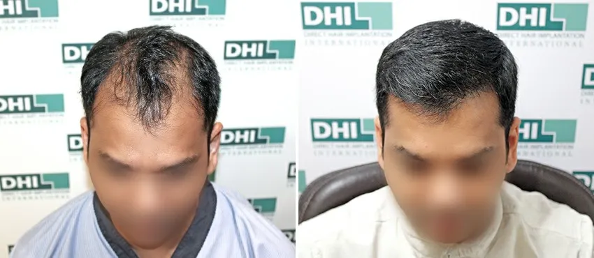 DHI before & after hair transplant results