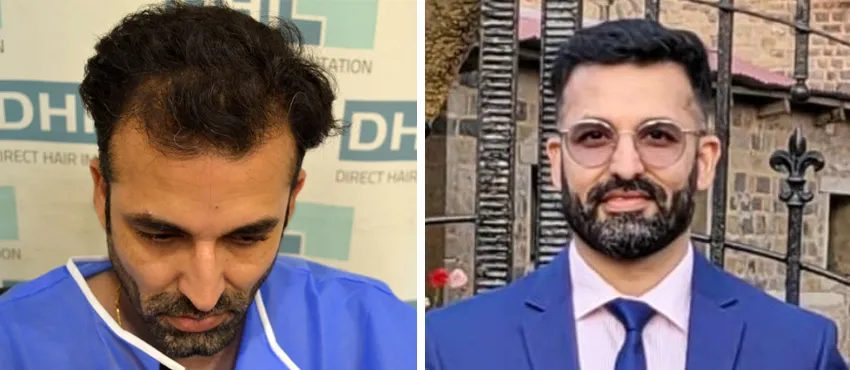 dhi gives natural hairline